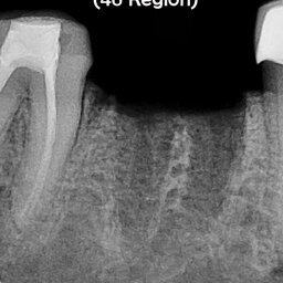 Flapless Single Implant Placement with Screw Retained PFM Prosthesis: Dr Akash Akinwar
