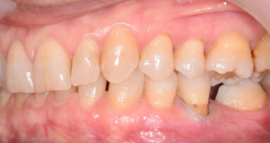 Progettazione ortodontica digitale di un caso di scissor bite