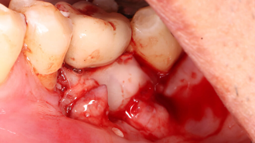 3D printing is not the perfect answer to periodontal regeneration, but it is getting close
