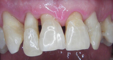 Indagine retrospettiva di follow-up a dieci anni dalla diagnosi e dal trattamento di parodontiti croniche e aggressive