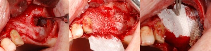 Fig. 4 - Chirurgia rigenerativa. Dopo avere aperto un lembo a tutto spessore, si procede all’antrostomia, allo scollamento della membrana sinusale e all’innesto del sostituto osseo, che è utilizzato anche per eseguire la rigenerazione verticale adiacente. I siti innestati sono protetti con due membrane in pericardio.