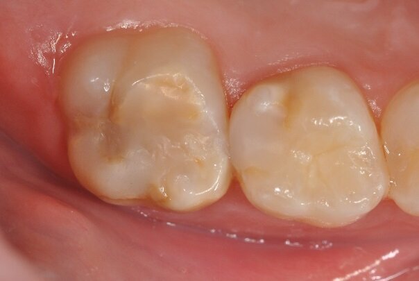 Restoration with resin composite is the treatment of choice for MIH-affected teeth. The resin effectively seals the affected surface, and composite is considered a good insulator against harmful substances. In addition, healthy hard tooth substance can be optimally preserved, since the filling material is directly bonded. Amalgam is contra-indicated as a filling material for MIH-affected teeth. (Photograph: Prof. Norbert Krämer)