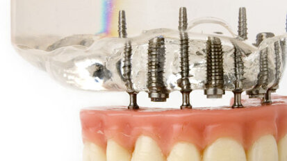 US scientists develop smart coating for dental implants US scientists develop smart coating for dental implants