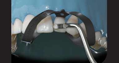 Create Beautiful Restorations with Akro‑Flex™