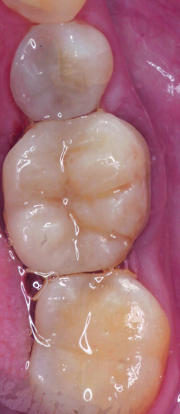 Fig. 18: Occlusal view of the excellent final results.