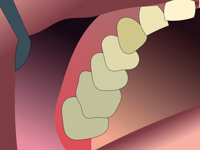 Fig. 8 : Situation initiale.