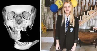 Dreadful horse-riding accident leaves girl with split mandible