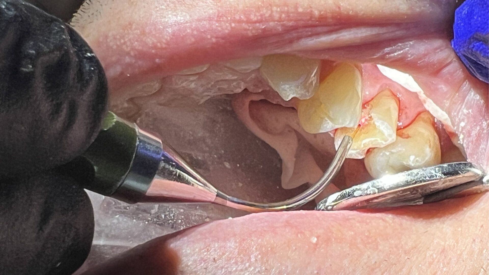 Laser treatment of pulpal exposure to potentially avoid endodontic treatment