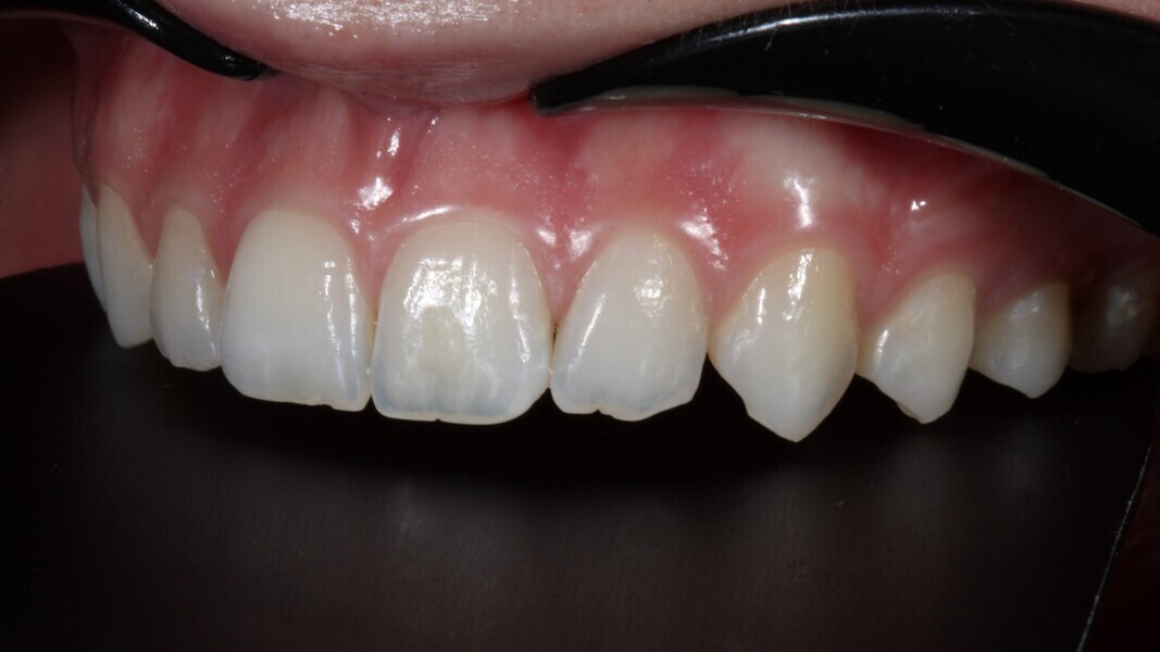 Fig. 4: Buccaal aanzicht. Anatomie van tand #22 en 23.