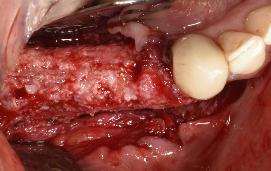 Fig. 8_Foto intra-operatoria dopo rimozione della griglia in titanio che evidenzia l’incremento osseo ottenuto.