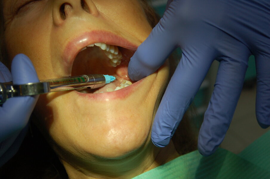 Fig. 1 - Anestesia del nervo inferiore alveolare.