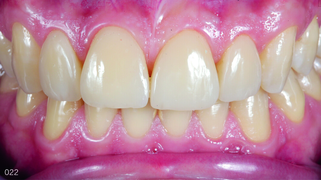 Fig. 21: Teeth in intercuspal position one year after the treatment, frontal view.
