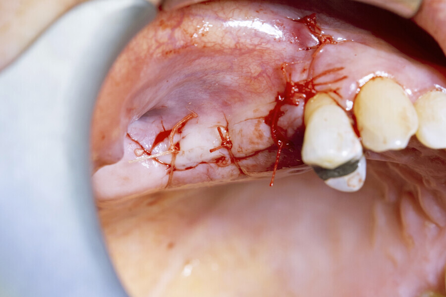 Fig. 10: Passive primary closure with PGA sutures.