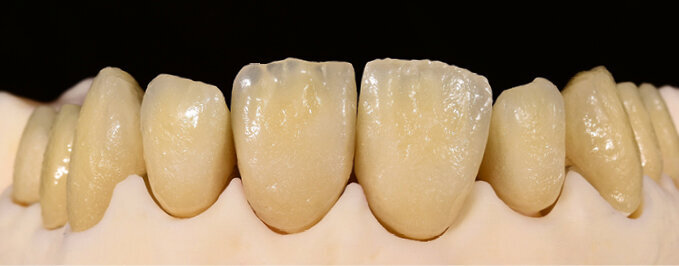 Fig. 10: Comparison of the crowns after the first firing (left: IPS d.SIGN; right: IPS Style)