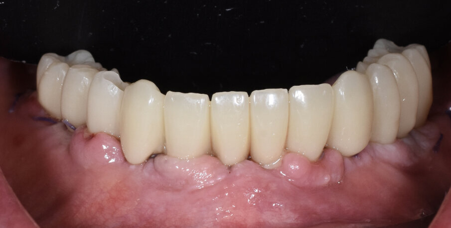 Fig. 21 - Carico immediato.