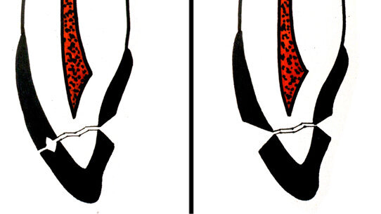 Traumatologia dentale in età pediatrica