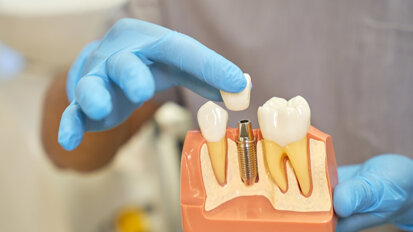 Geistlich webinar to explore AI and precision approaches in implant dentistry