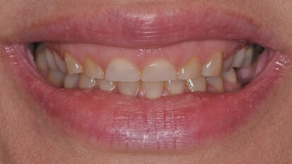 Comprehensive aesthetic transformation: Integrating hard- and soft-tissue treatments using the FotonaSMILE approach