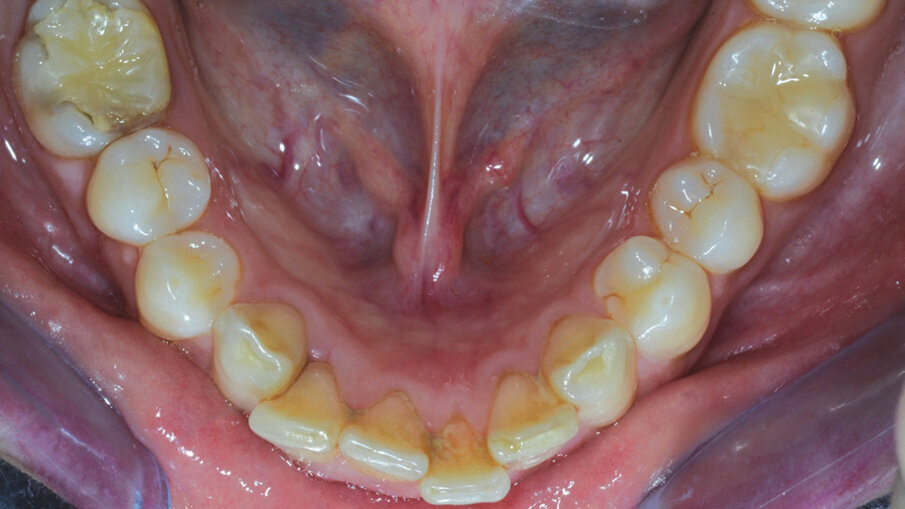 Figg. 4g, 4h_Foto occlusali di inizio trattamento.