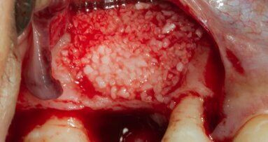 Rigenerazione ossea orizzontale con lamina corticale collagenata stabilizzata con colla di fibrina e viti da osteosintesi: case report