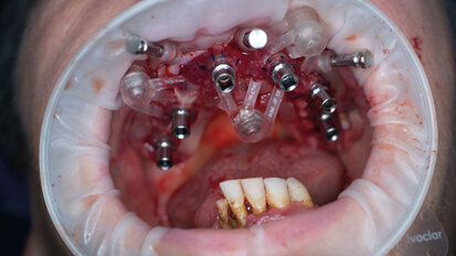 Riabilitazione full-arch a carico immediato guidato con dime scomposte e impianti EVO GHIMAS