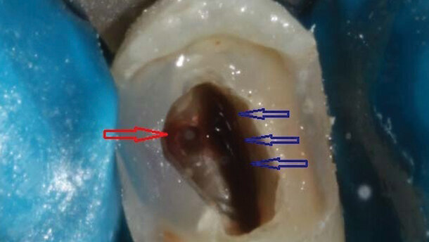 Ritrattamento endodontico e restauro adesivo di un secondo premolare strutturalmente compromesso