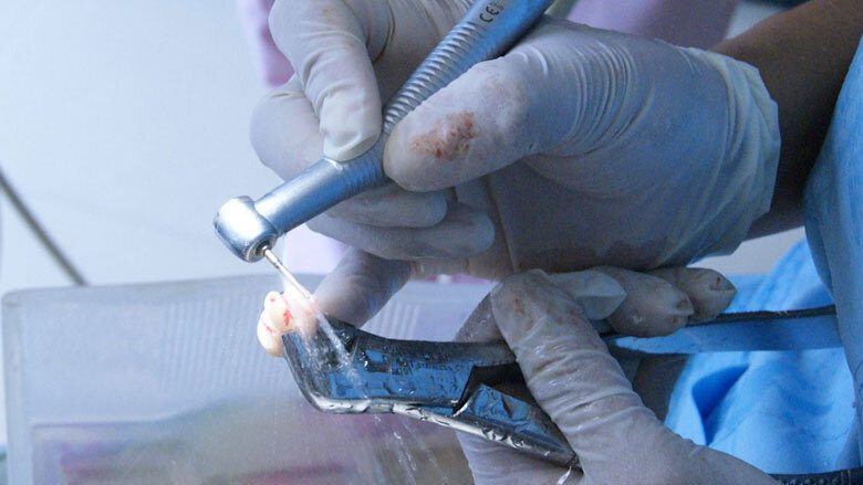 Figura 4. Apicectomía del diente 46.