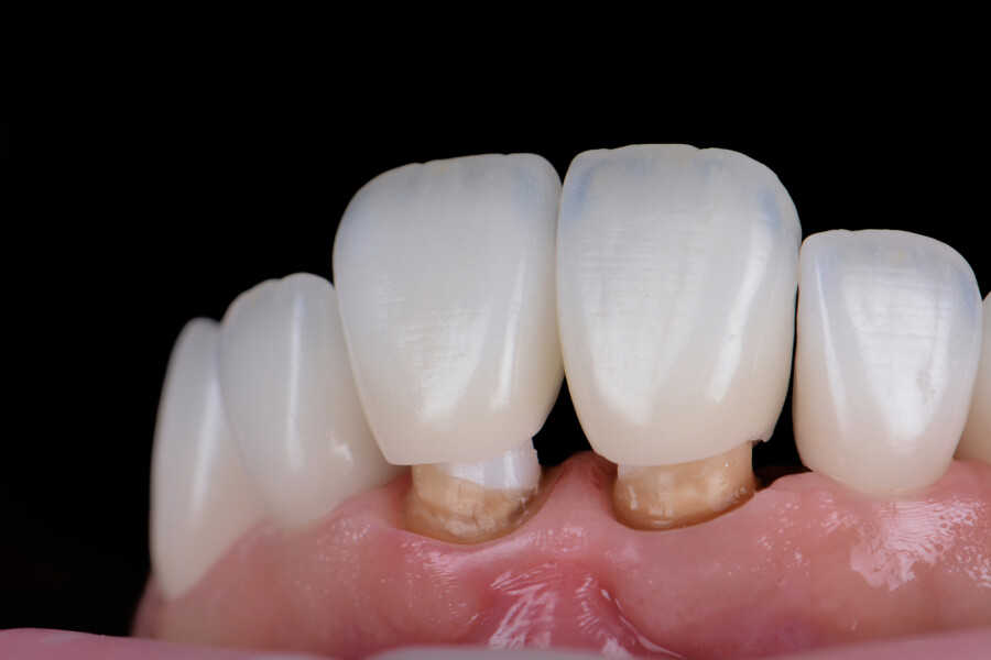 Fig. 28: Intra-oral try-in of the restorations.
