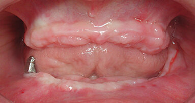 Rehabilitación con prótesis híbrida cerámica