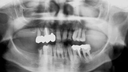 Fig. 4 Prótesis Híbrida inmediata y radiografía control con 6 años post-operatorio .Fig. 4 Prótesis Híbrida inmediata y radiografía control con 6 años post-operatorio