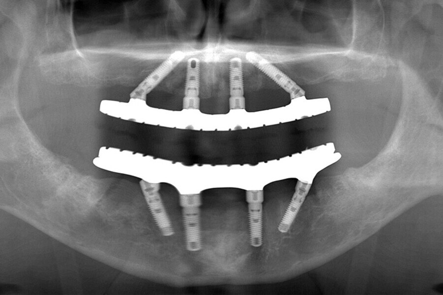 Fig. 18. Rx Pre-operatoria, Prótesis híbrida inmediata con 6 años de evolución y Rx Control a los 6 años.