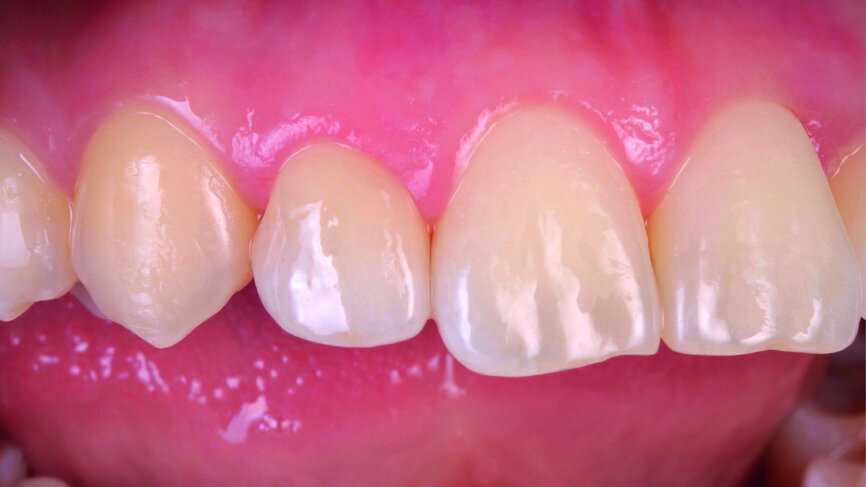 Fig. 23: Final outcome after the completion of the treatment.