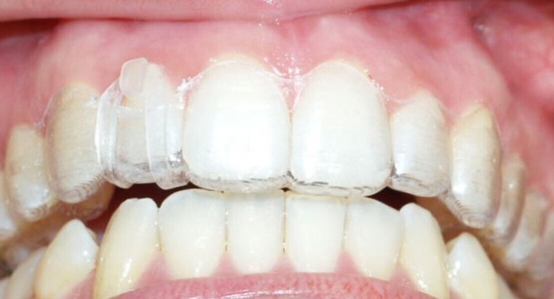 Fig. 6: Extrusion elastic in place.