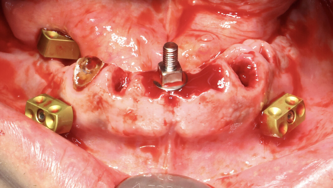Fig. 8b: Preparation for robotic computer-assisted implant surgery. Fixation screw placed to stabilise the optical tracking array.