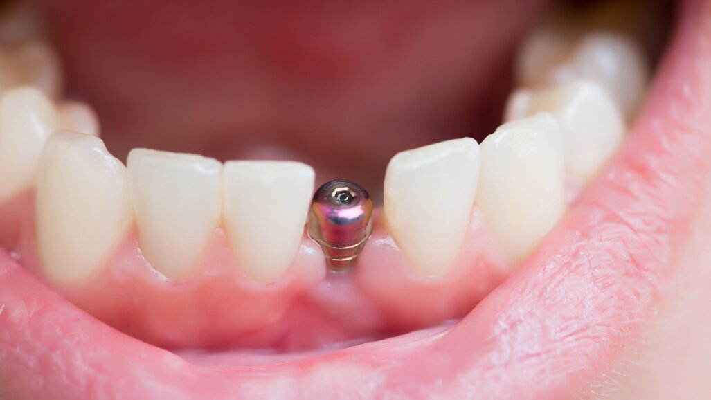 Researchers find that some periodontic residency programmes are reusing healing abutments