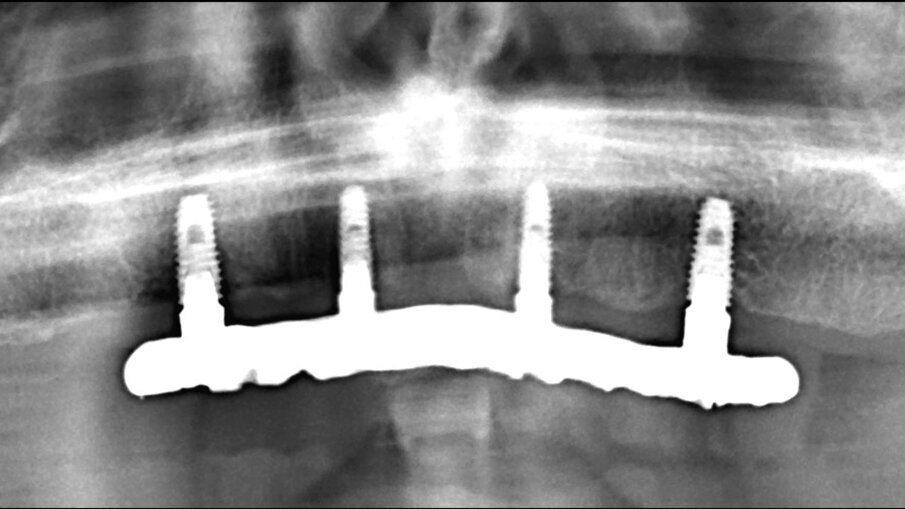Fig. 20_Esempio di una rx di una protesi fissa con follow-up di 6 anni. L’importanza dell’igiene oltre a tutti i fattori progettuali.