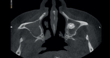 Complicaciones postoperatorias