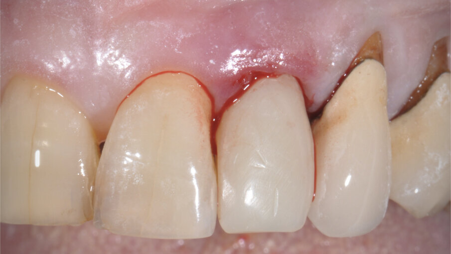 Fig. 8_Provvisorio in sede con matrice dermica inserita sotto i tessuti molli.