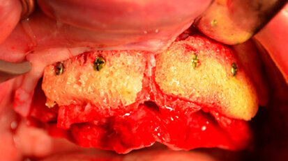 Madrid 2-3 giugno 2016: seminario di approfondimento formativo teorico-pratico di alta chirurgia su dissezione anatomica