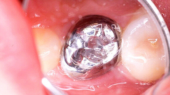Cochrane finds crowns superior to dental fillings