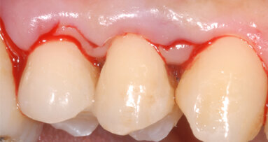 Single Flap Approach. Un approccio chirurgico semplificato ai difetti ossei parodontali