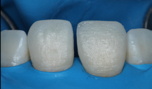 Fig. 8: Emergence profile of the 1st tooth