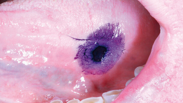 Oral cancer: il 47% dei casi diagnosticati tardivamente, perché?