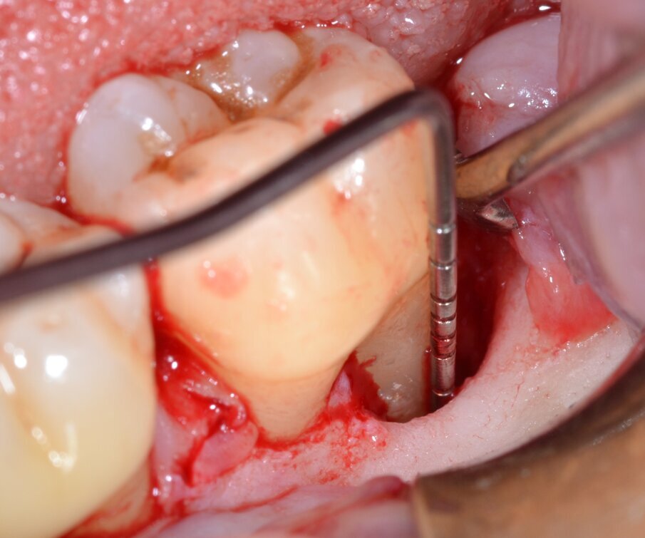 Fig. 5 - Sondaggio della componente intraossea del difetto.