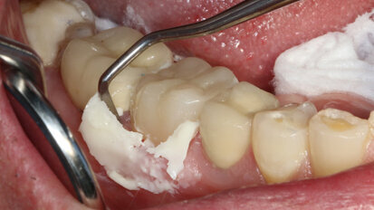 Benefits of bonding meet the simplicity of traditional cementing