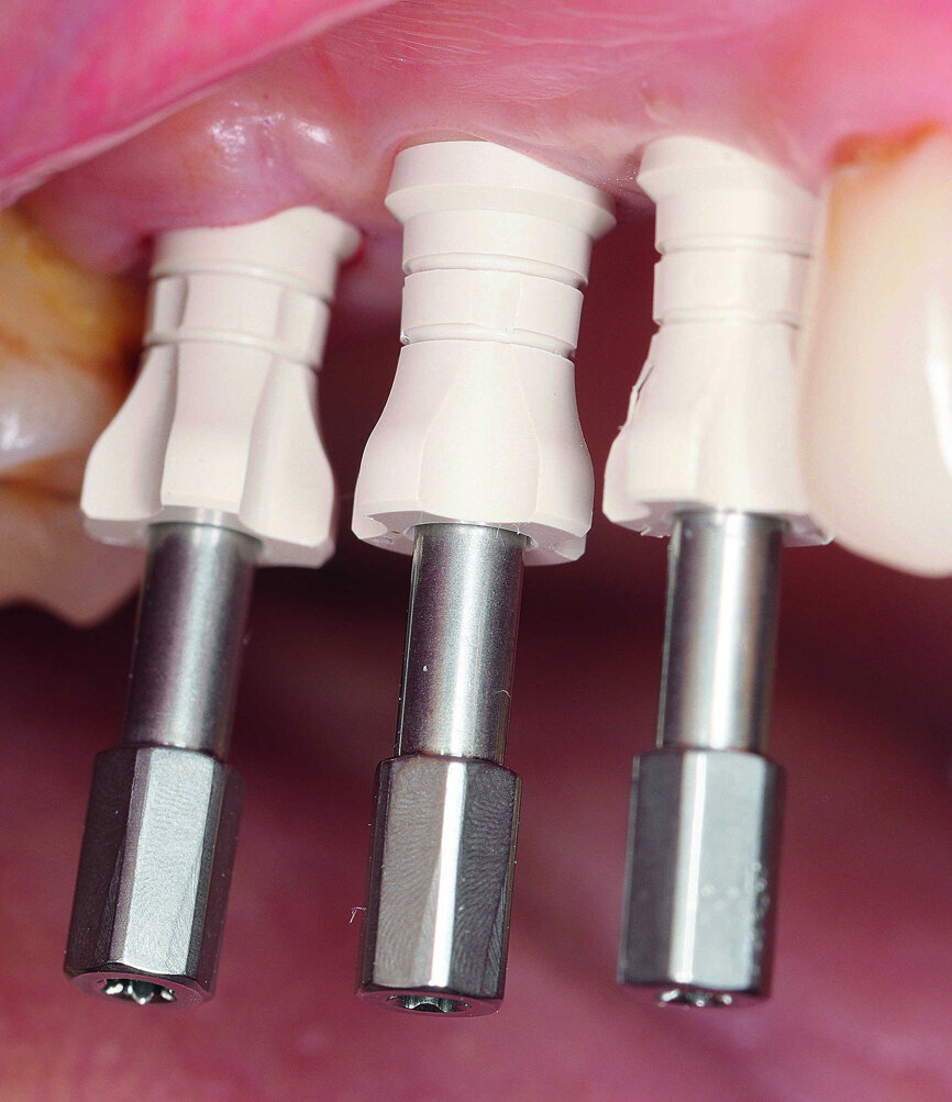 Fig. 19 : Vue latérale des coiffes d’empreinte. 