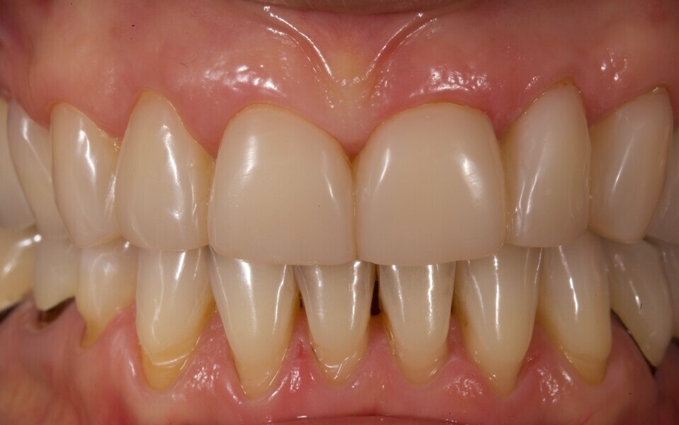 Fig. 15b: Frontal view with the teeth in occlusion.