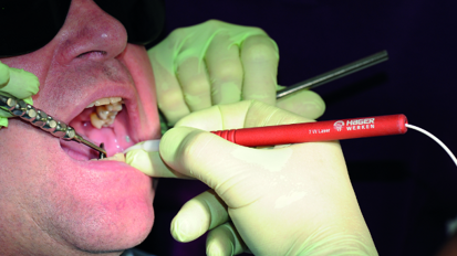 Diode laser application optimises the clinical outcomes of digital workflow