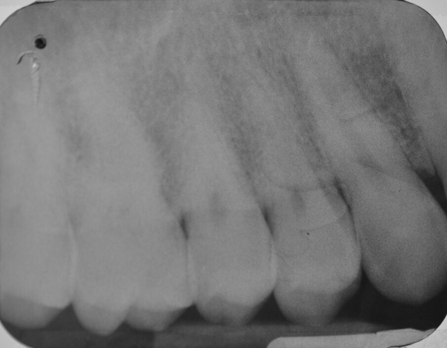 Fig. 3 - Esame radiografico endorale preoperatorio.
