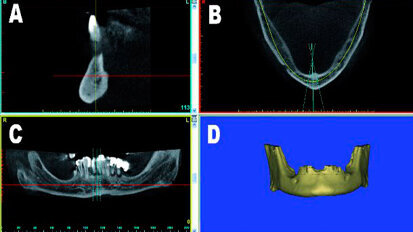 Guida alla riduzione ossea: concetti di pianificazione virtuale in 3D per protesi mandibolare full-arch su impianti